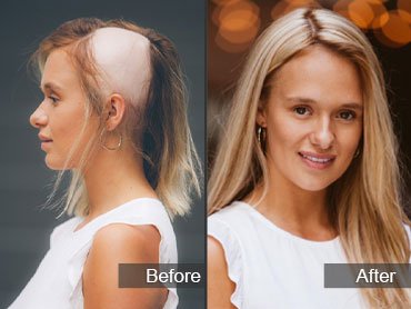 Alopecia Wigs A Solution to A Hair Loss Condition Continental Hair